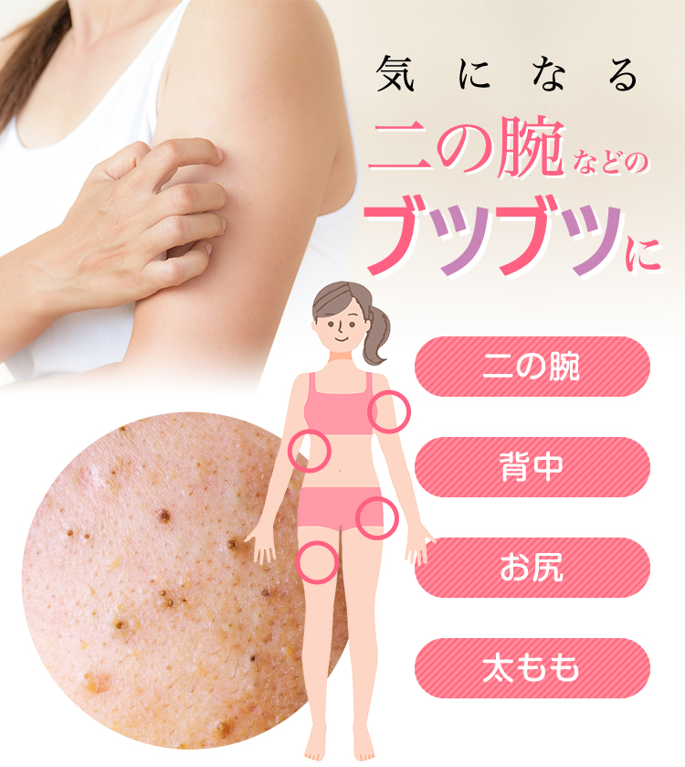 気になる二の腕のブツブツ・ニキビに ピュアルピエ ～Pure Lupie～